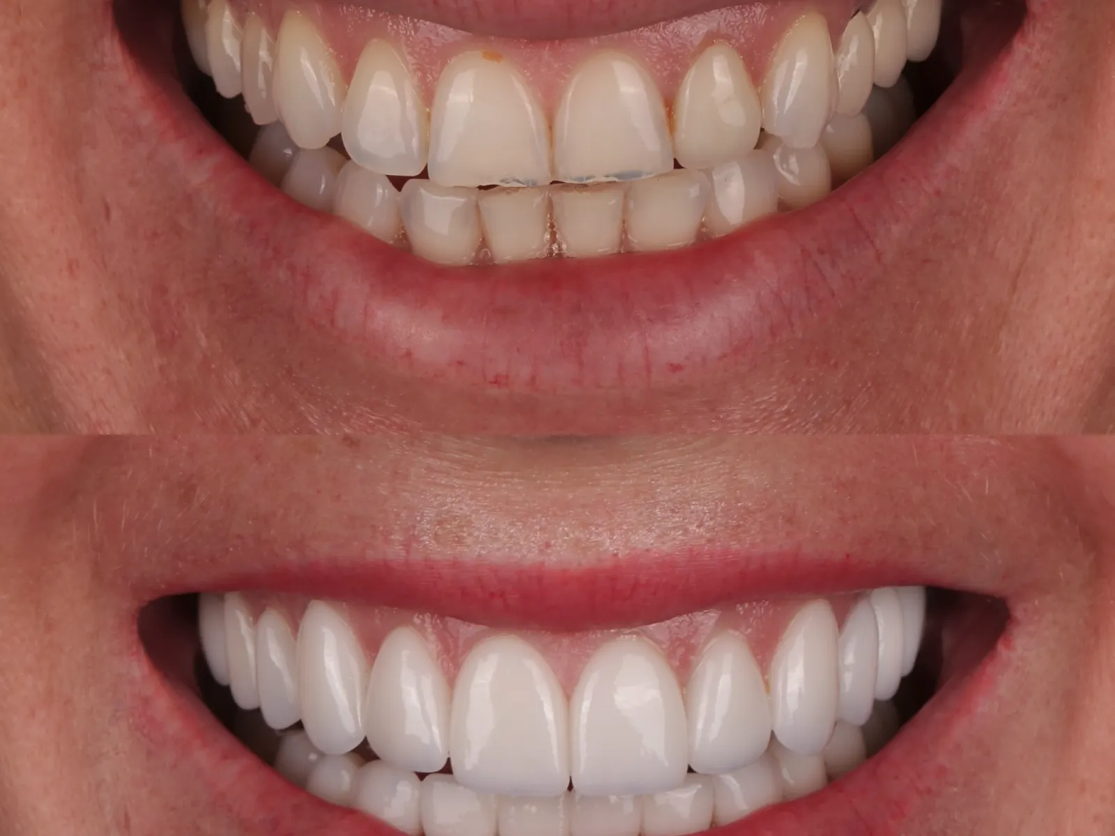 Finished porcelain smile, close-up